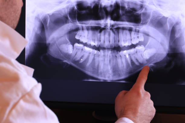 Best Emergency Wisdom Teeth Removal in St Marys, PA